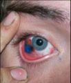 Tatuaje en el ojo